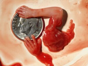 Aborto 10 semanas 10