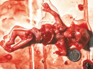 Aborto 10 semanas 11