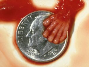 Aborto 10 semanas 14