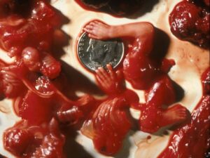 Aborto 10 semanas 16