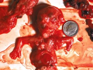 Aborto 10 semanas 17