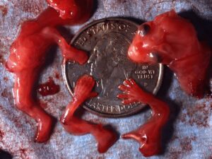 Aborto 10 semanas 18