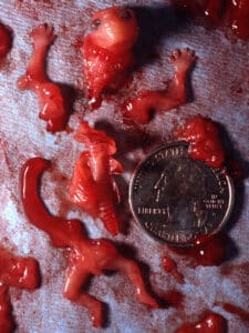 Aborto 10 semanas 021