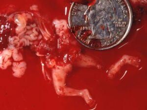 Aborto 10 semanas 025