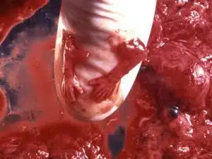 Aborto 11 semanas 01