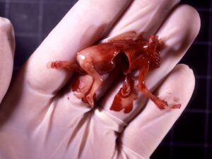 Aborto 11 semanas 03