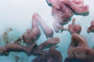 Aborto 12 semanas 01