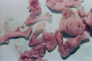 Aborto 12 semanas 03