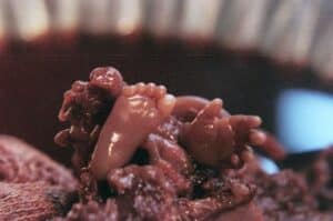 Aborto 16 semanas 010