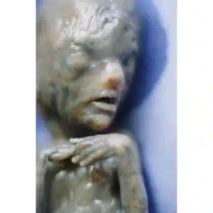 Aborto 18 semanas 01