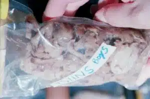 Aborto 18 semanas 03