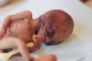 Aborto 20 semanas 01