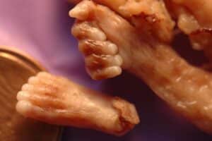 Aborto 20 semanas 04