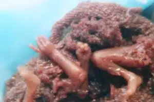 Aborto 20 semanas 07