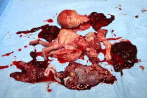 Aborto 20 semanas 08
