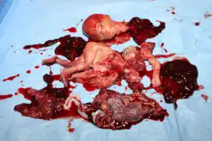 Aborto 20 semanas 08
