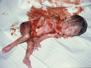 Aborto 22 semanas 01