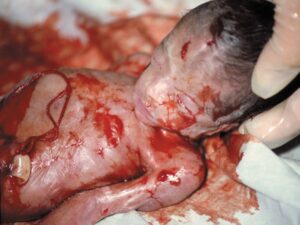 Aborto 22 semanas 03
