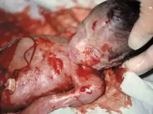 Aborto 22 semanas 03