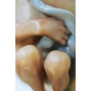 Aborto 24 semanas 02