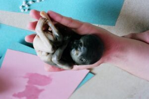 Aborto 24 semanas 03