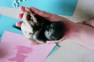 Aborto 24 semanas 03