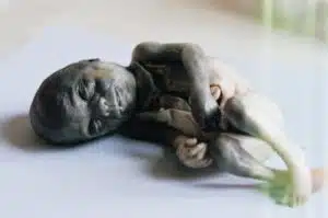 Aborto 24 semanas 07