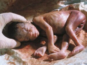 Aborto 24 semanas 09