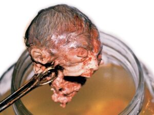 Aborto 26 semanas 01