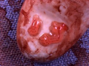 Aborto 7 semanas 05