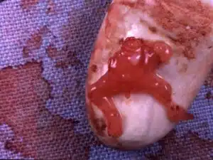 Aborto 7 semanas 06