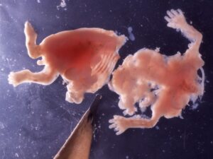 Aborto 8 semanas 010