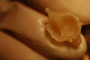 Aborto 8 semanas 05