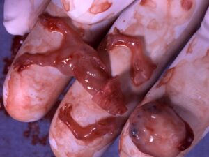 Aborto 8 semanas 07