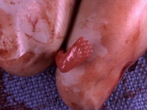 Aborto 8 semanas 09