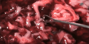 Abortamento 001