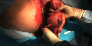 Abortamento 002