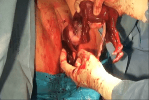 Abortamento 004