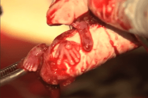 Abortamento 005