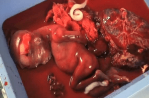 Abortamento 010