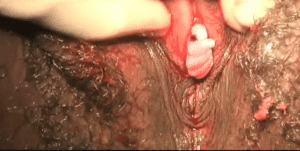 Abortamento 012