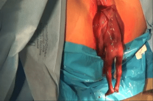 Abortamento 013