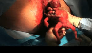 Abortamento 015