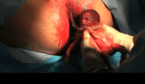 Abortamento 016