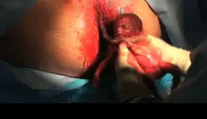 Abortamento 016