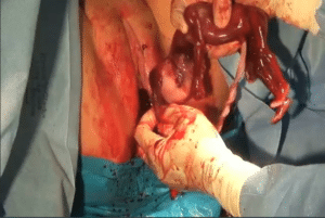 Abortamento 024
