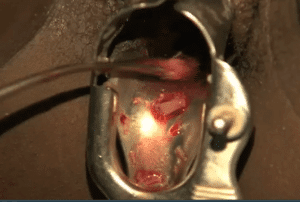 Abortamento 025