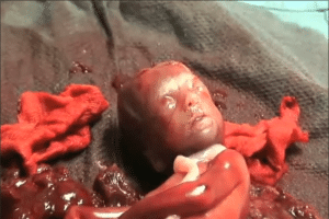 Abortamento 026