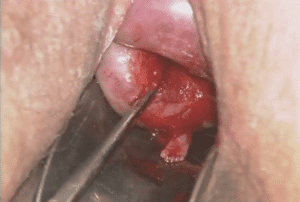 Abortamento 028
