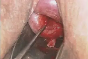Abortamento 028